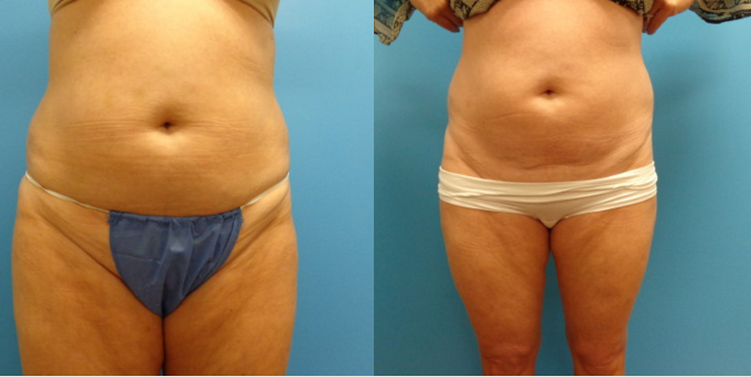 Laser Center Of Miami Spa Miami Fl Laser Center Of Miami Spa Miami Fl