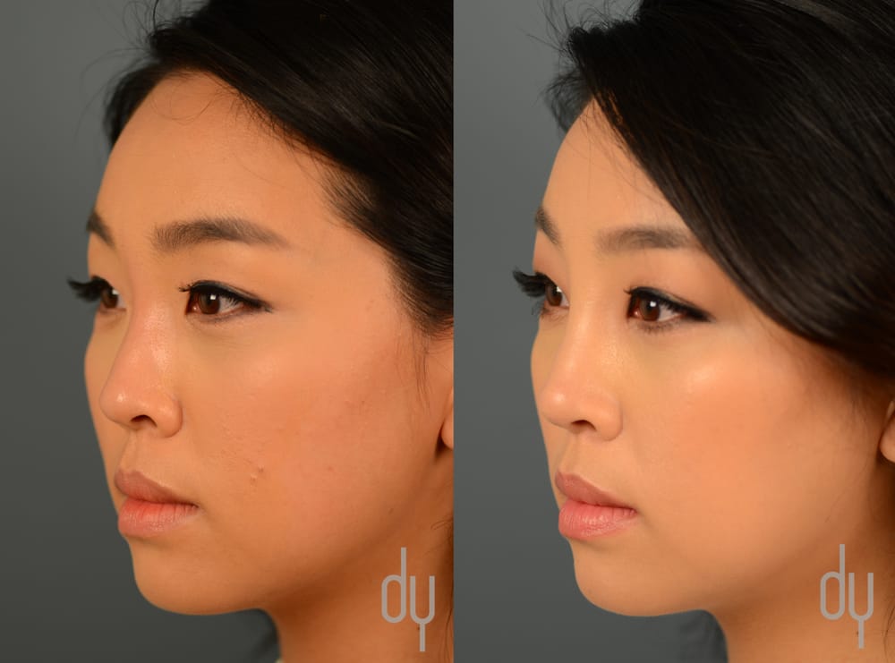 Asian Nose Job Before After 59