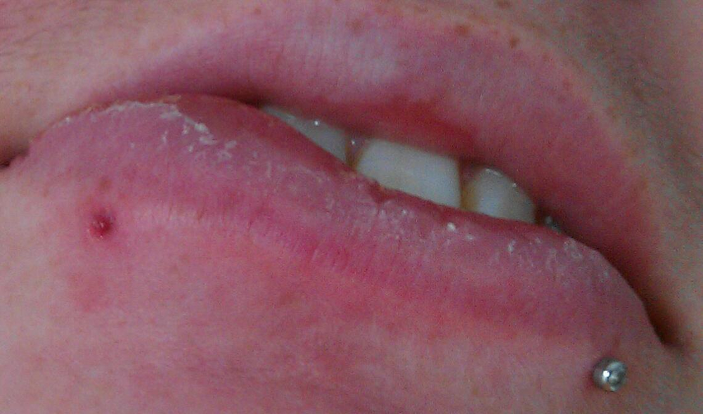 My swollen lip when my jewlery began sinking. (Excuse the unbrushed