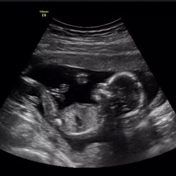 3d 46 4d ultrasound