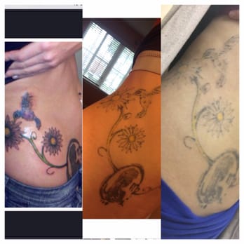 Photo Of Skin Deep Laser Medspa Pasadena Ca United States Tattoo Removal Photo Of Skin Deep Laser Medspa Pasadena Ca United States Tattoo Removal