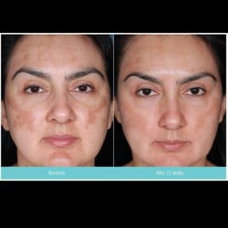 Facial surgery san dimas Male facial clips