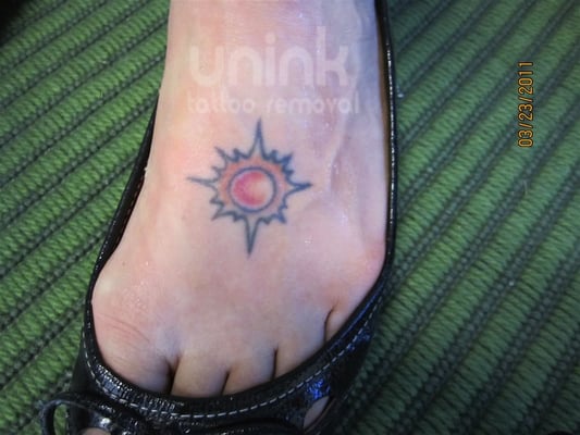 unink tattoo removal closed tattoo removal 420 n carroll ave unink tattoo removal closed tattoo removal 420 n carroll ave