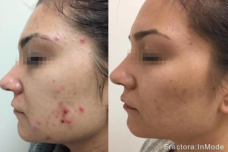 cystic acne svenska cystic acne svenska