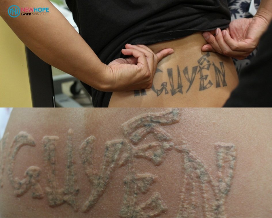 10 minutes after the first laser tattoo removal treatment with dr 10 minutes after the first laser tattoo removal treatment with dr