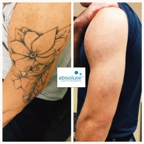 Photo Of Absolute Laser Tattoo Removal Hermosa Beach Ca United States Before Photo Of Absolute Laser Tattoo Removal Hermosa Beach Ca United States Before