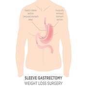 gastric sleeve operation sverige gastric sleeve operation sverige