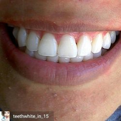 Smilelabs Of Pleasanton 19 Photos 23 Reviews Teeth Whitening Smilelabs Of Pleasanton 19 Photos 23 Reviews Teeth Whitening 818 Main St Ca Phone Number Yelp