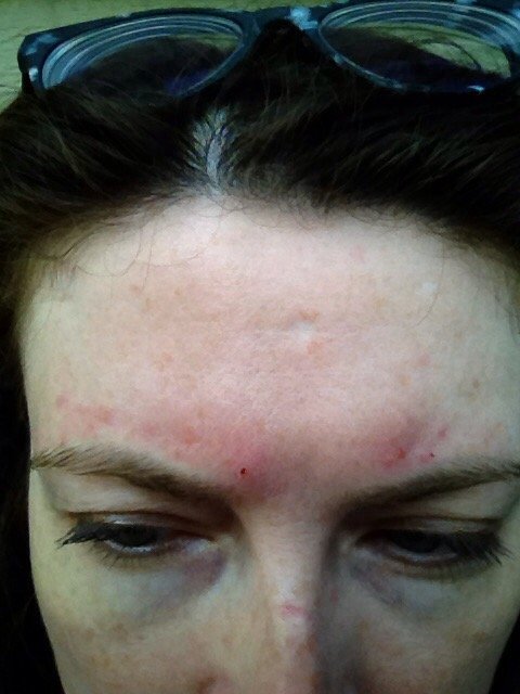Eyebrow Hair Infection
