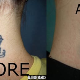 Tattoo Vanish Nyc | tattoo vanish nyc closed tattoo removal 7802 13th Tattoo Vanish Nyc | tattoo vanish nyc closed tattoo removal 7802 13th