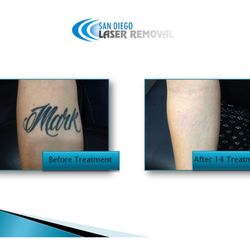 San Diego Laser Tattoo Removal - 11 Fotos &amp; 44 Beiträge 