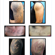 removing barriers tattoo removal 18 photos u0026 35 reviews tattoo removing barriers tattoo removal 18 photos u0026 35 reviews tattoo