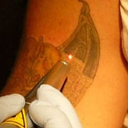 Photo Of Palm Beach Tattoo Removal Wellington Fl United States Photo Of Palm Beach Tattoo Removal Wellington Fl United States