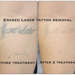 erased laser tattoo removal 65 photos u0026 57 reviews tattoo erased laser tattoo removal 65 photos u0026 57 reviews tattoo