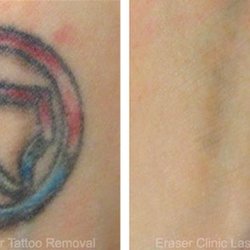 eraser clinic laser tattoo removal 68 photos u0026 19 reviews eraser clinic laser tattoo removal 68 photos u0026 19 reviews