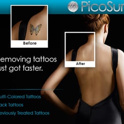 adieu tattoo removal tattoo removal 2000 engel st madison wi adieu tattoo removal tattoo removal 2000 engel st madison wi