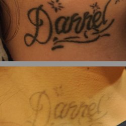 beloved laser tattoo removal 21 photos tattoo removal 1563 beloved laser tattoo removal 21 photos tattoo removal 1563