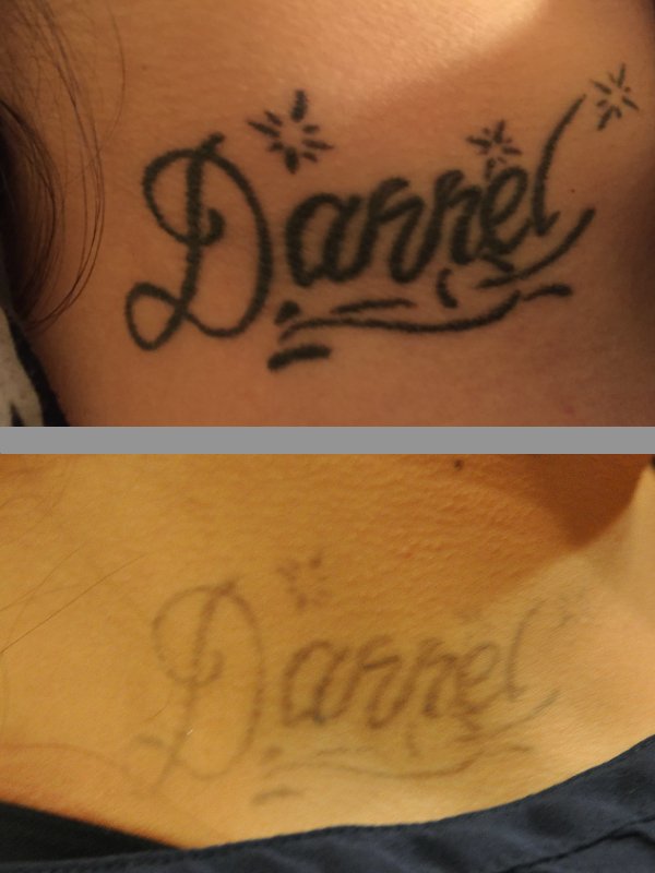 beloved laser tattoo removal 21 photos tattoo removal 1563 beloved laser tattoo removal 21 photos tattoo removal 1563