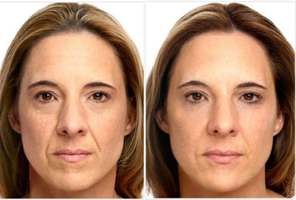 Facial fillers comparison — photo 10