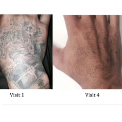 tattoo removal tattoo removal 5580 imperial hwy south gate tattoo removal tattoo removal 5580 imperial hwy south gate