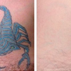 Photo Of Eraser Clinic Laser Tattoo Removal San Antonio Tx United States Photo Of Eraser Clinic Laser Tattoo Removal San Antonio Tx United States