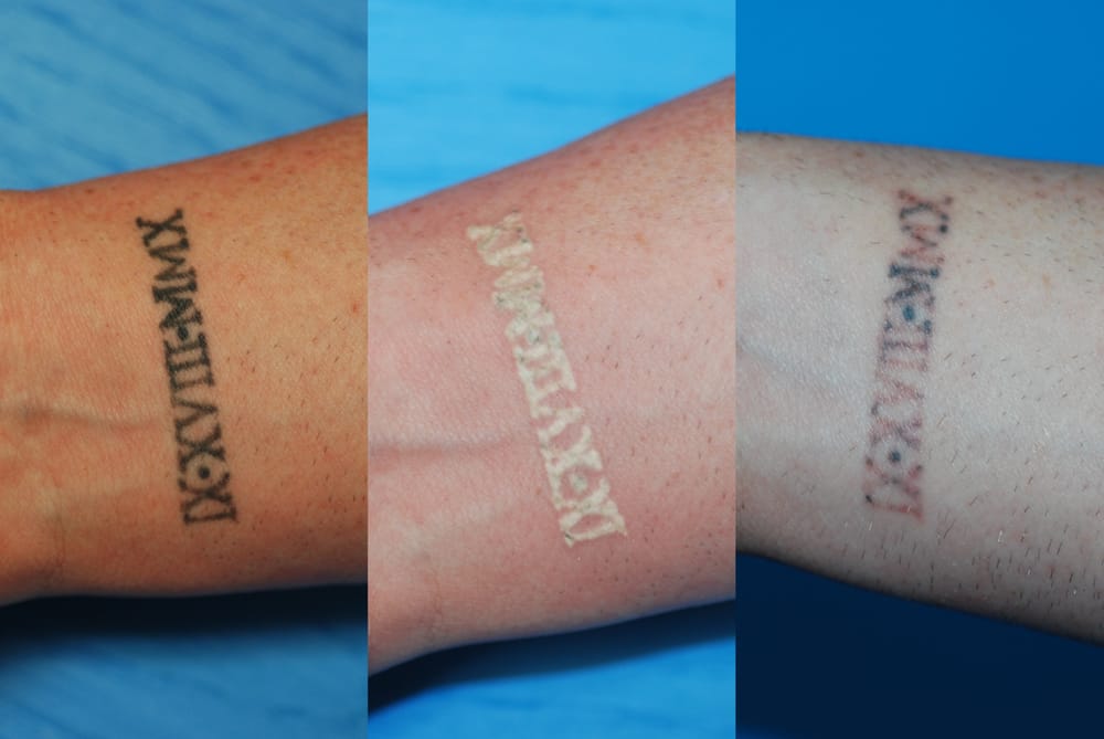 the laser institute of pinehurst medical spas 80 aviemore ct the laser institute of pinehurst medical spas 80 aviemore ct