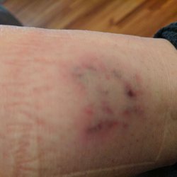 louisville laser laser hair removal reviews louisville ky louisville laser laser hair removal reviews louisville ky