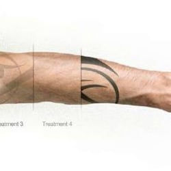 hindsight tattoo removal atlanta cheap tattoo removal near me hindsight tattoo removal atlanta cheap tattoo removal near me