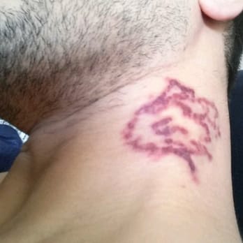 absolute laser tattoo removal 48 photos u0026 58 reviews tattoo absolute laser tattoo removal 48 photos u0026 58 reviews tattoo