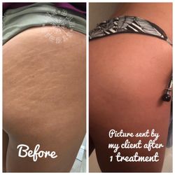 Permanent Makeup Tattoo For Stretch - Permanent Makeup For Stretch Marks Permanent Makeup Tattoo For Stretch - Permanent Makeup For Stretch Marks
