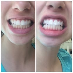 Gleam Whitening Closed 16 Reviews Teeth 3432 Photo Of Gleam Whitening Austin Tx United States