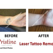 pristine laser center 38 photos u0026 12 reviews laser hair pristine laser center 38 photos u0026 12 reviews laser hair