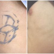 advanced laser tattoo removal 10 photos u0026 18 reviews tattoo advanced laser tattoo removal 10 photos u0026 18 reviews tattoo