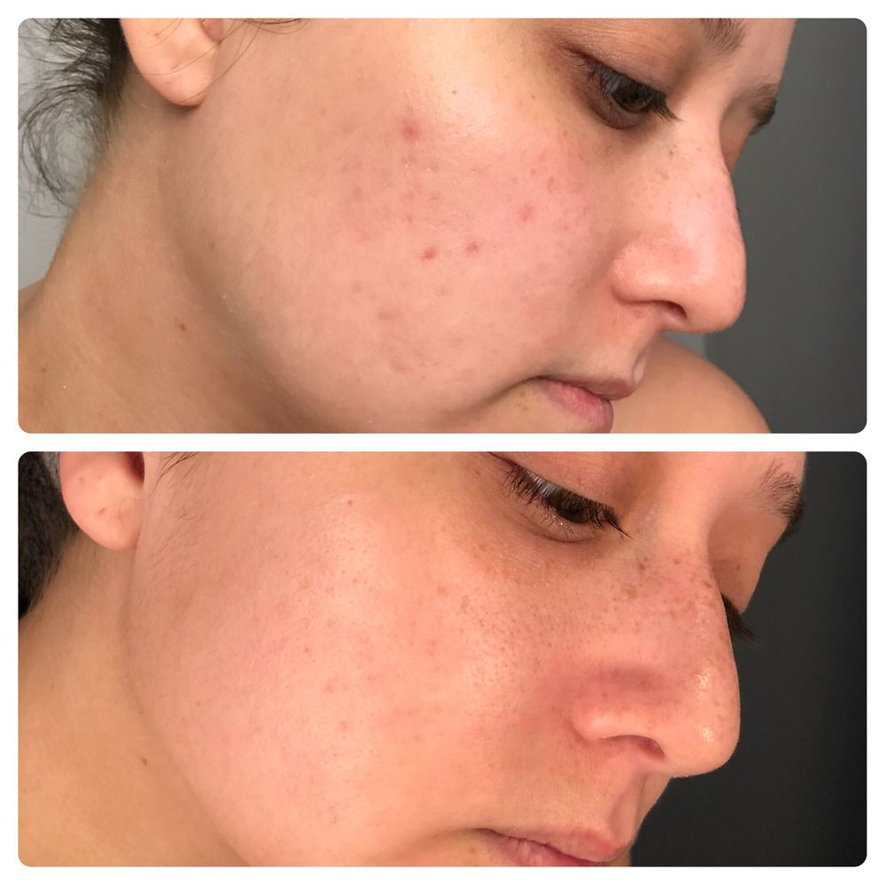 Liberation Acne Clinic Skin Care 3614 N 24th St, Phoenix, AZ