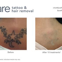 bare tattoo u0026 hair removal tattoo removal 9339 calumet ave bare tattoo u0026 hair removal tattoo removal 9339 calumet ave