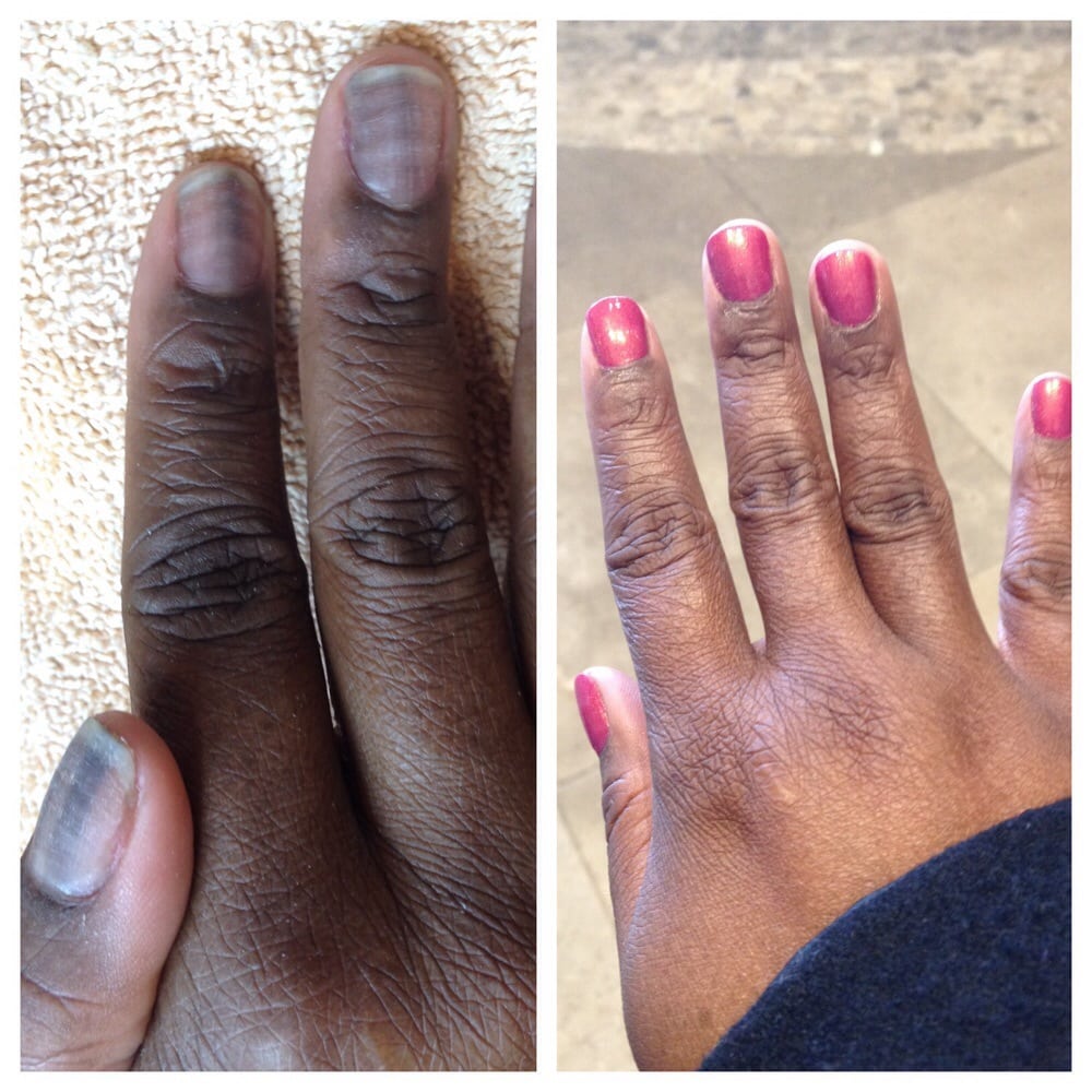 Chemo Nails Before Black Lines And Ridges After T 87 Photos For Blu Water Day Spa Salon