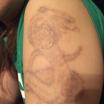 Eraser Clinic Laser Tattoo Removal - 81 Photos &amp; 21 