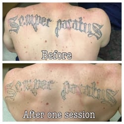 absolute laser tattoo removal 48 photos u0026 58 reviews tattoo absolute laser tattoo removal 48 photos u0026 58 reviews tattoo
