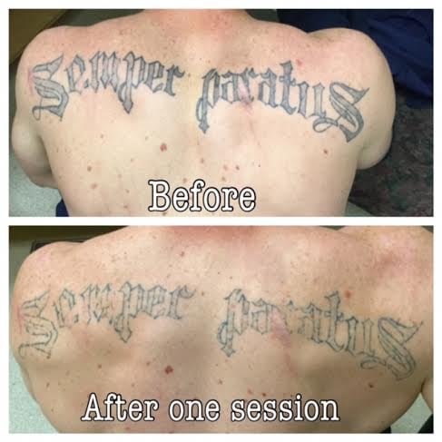 Photo Of Absolute Laser Tattoo Removal Sango Ca United States Before Photo Of Absolute Laser Tattoo Removal Sango Ca United States Before