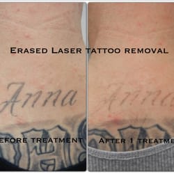 erased laser tattoo removal 65 photos u0026 57 reviews tattoo erased laser tattoo removal 65 photos u0026 57 reviews tattoo