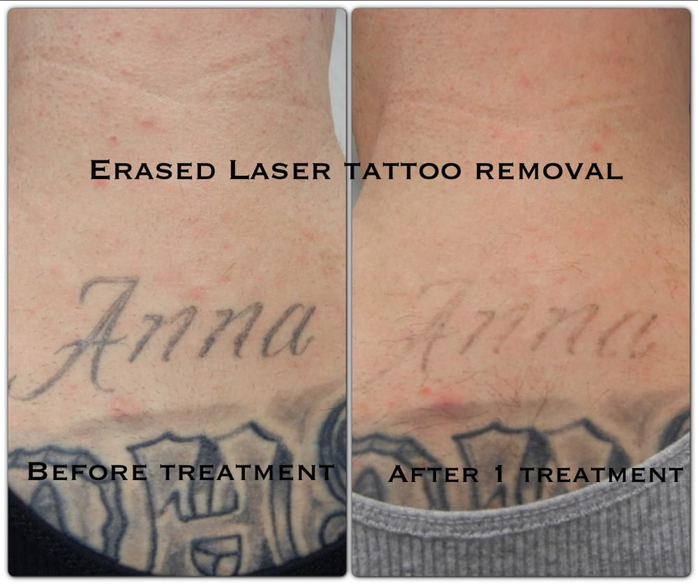 photos for erased laser tattoo removal yelp photos for erased laser tattoo removal yelp