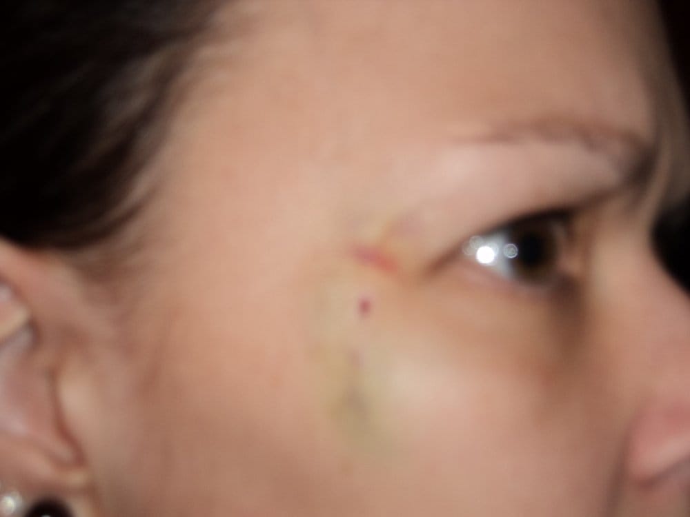 the red dot is where the dermal piercing was the rest the red dot is where the dermal piercing was the rest