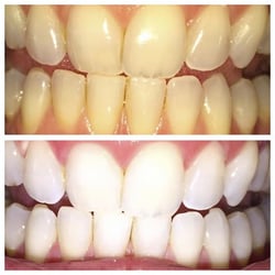 Davinci Teeth Whitening Santa Rosa 43 Photos 16 Reviews Photo Of Davinci Teeth Whitening Santa Rosa Ca United States