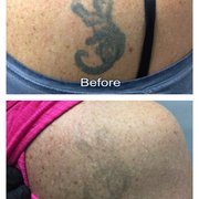 disappearing ink tattoo removal 106 nelbon ave pittsburgh pa disappearing ink tattoo removal 106 nelbon ave pittsburgh pa
