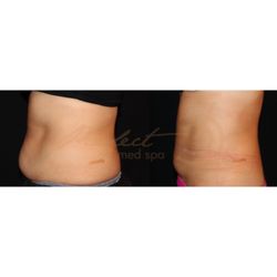 The Best 10 Laser Hair Removal Near Mdcs Medical Dermatology