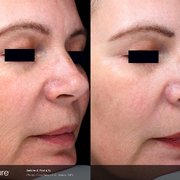 midwest laser center tattoo removal 140 chesterfield commons e midwest laser center tattoo removal 140 chesterfield commons e