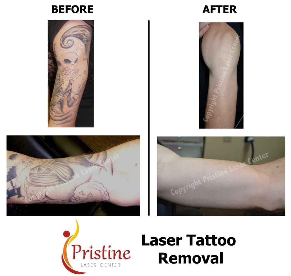 half sleeve tattoo removal yelp half sleeve tattoo removal yelp