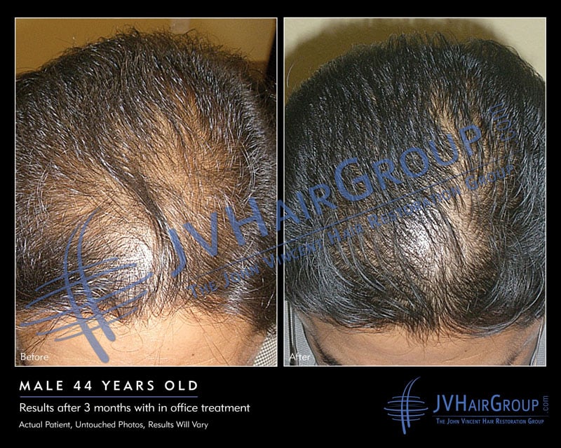 the john vincent hair restoration group closed laser hair removal 1035 peach st san luis obispo ca phone number yelp - Laser Hair Treatment the john vincent hair restoration group closed laser hair removal 1035 peach st san luis obispo ca phone number yelp - Laser Hair Treatment