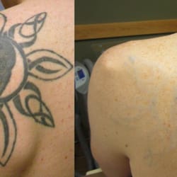 blink tattoo removal 10 photos u0026 13 reviews tattoo removal blink tattoo removal 10 photos u0026 13 reviews tattoo removal