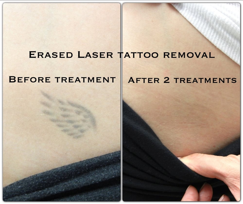 after the 2nd treatment erased tattoo removal las vegas www after the 2nd treatment erased tattoo removal las vegas www